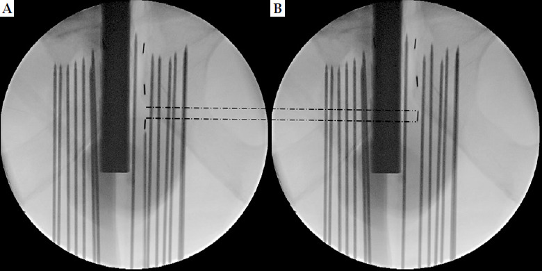 A prospective comparison of implant quality between suture-coated seeds and uncoated seeds in prostate cancer brachytherapy.