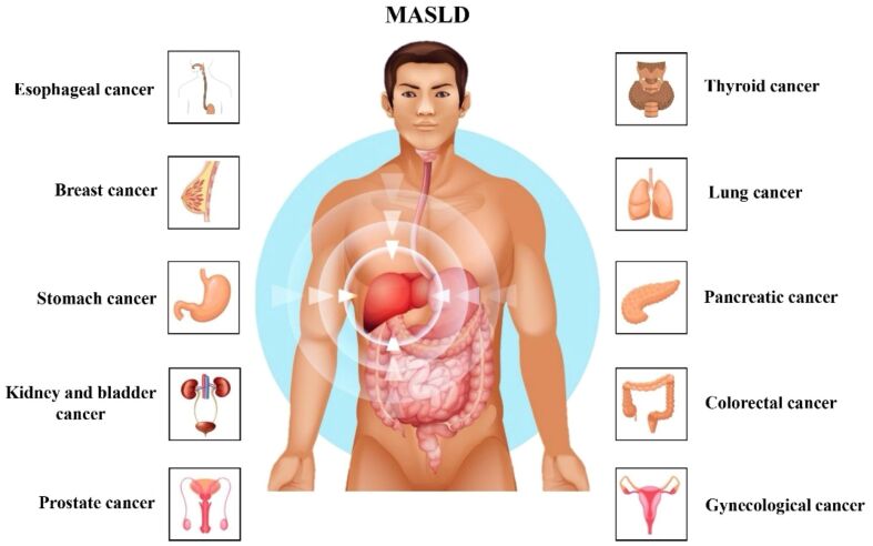 The burden of cancer in metabolic dysfunction-associated steatotic liver disease.