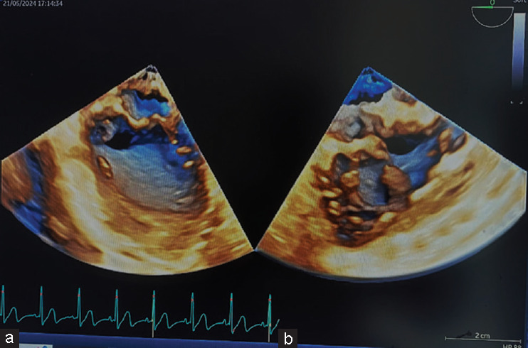 Pediatric Three-dimensional Transesophageal Echocardiography: A Game Changer in Congenital Heart Disease.