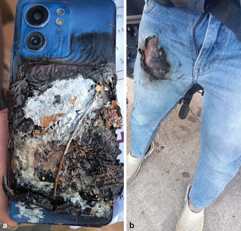 Spontaneous Mobile Phone Blast Burn Injury.