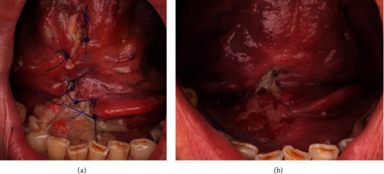 The Sublingual Gland Flap for Oral Reconstruction: Insights From a Single Institutional Experience.