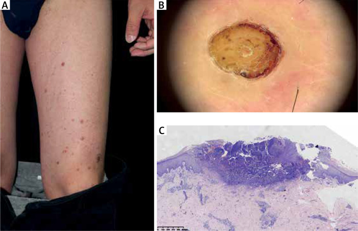 A case of acquired reactive perforating collagenosis after COVID-19 infection.