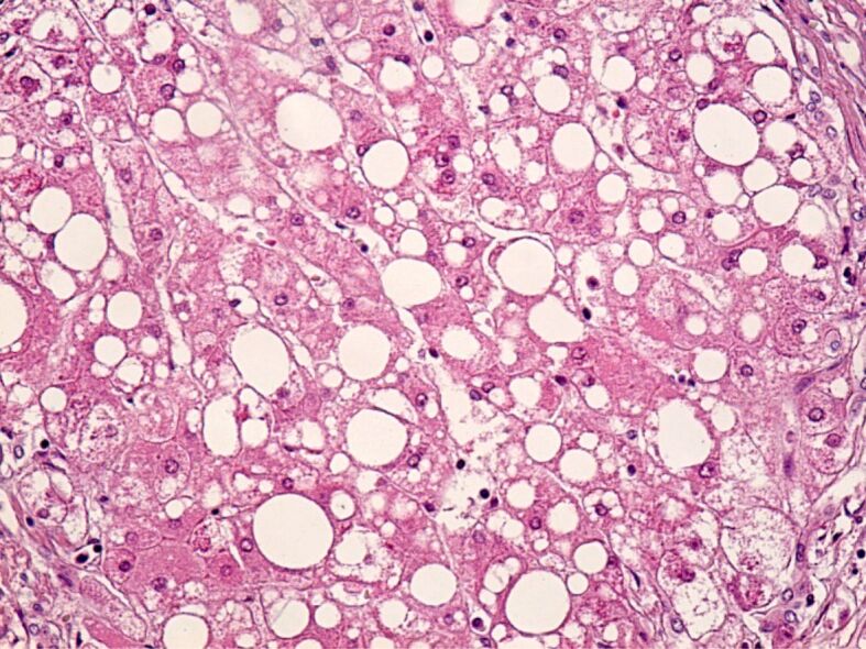 The burden of cancer in metabolic dysfunction-associated steatotic liver disease.