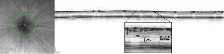 Impact of transcranial Direct Current Stimulation on stereoscopic vision and retinal structure in adult amblyopic rodents.
