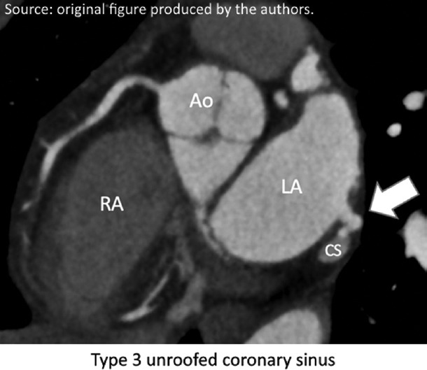Cardiac Computed Tomography Detected the Hidden Culprit of a Cryptogenic Stroke: A "Cold" Case.