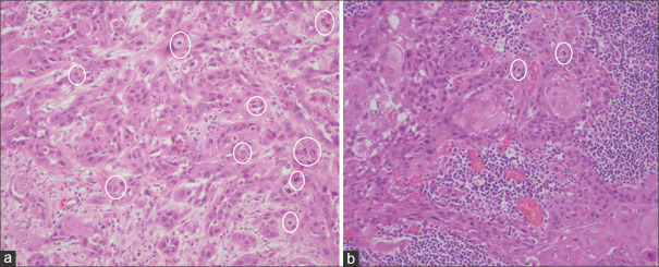 Mitosis - predicting primary tumour and metastatic lymph node behaviour and beyond in OSCC - A pilot study.
