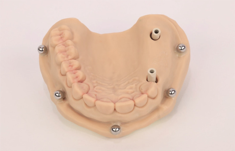 Effect of reference objects on the accuracy of digital implant impressions in partially edentulous arches.