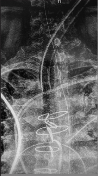 Intraoperative Innovation Leading to a Modified Endotracheal Tube: A Case Report of Endobronchial Intubation of Total Laryngectomy Stoma.