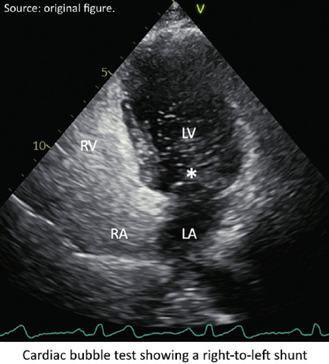 Cardiac Computed Tomography Detected the Hidden Culprit of a Cryptogenic Stroke: A "Cold" Case.