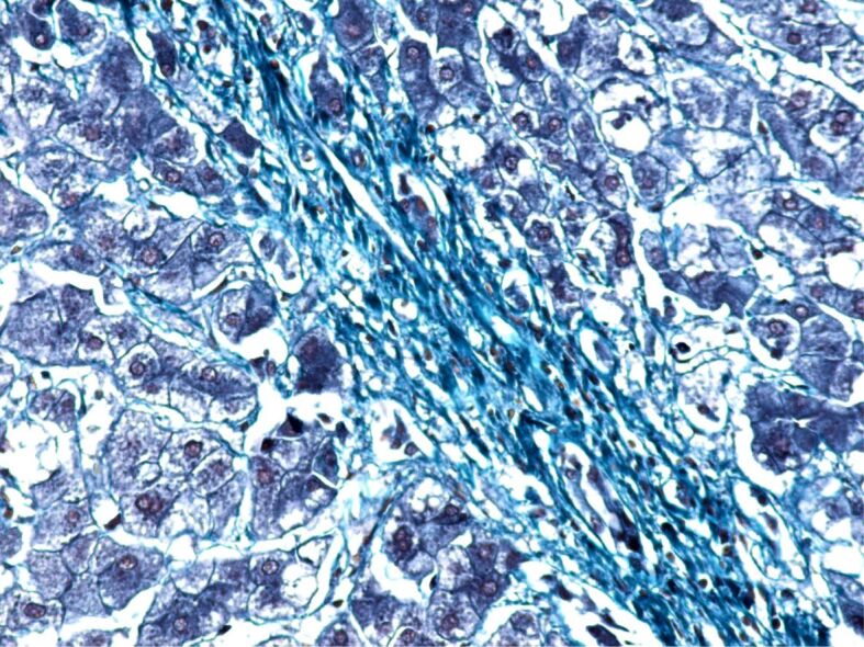 The burden of cancer in metabolic dysfunction-associated steatotic liver disease.