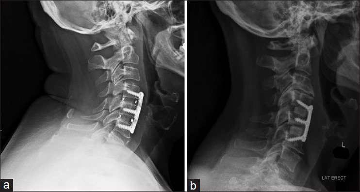 Radiographic outcomes and subsidence rate in hyperlordotic versus standard lordotic interbody spacers in patients undergoing anterior cervical discectomy and fusion.