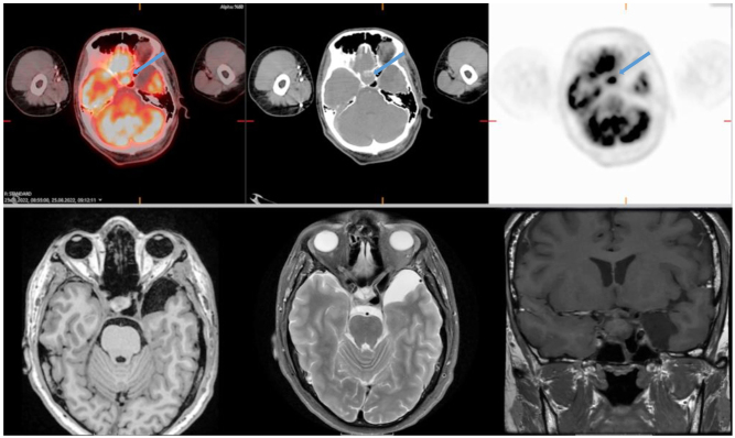 Complete remission after glucocorticoid therapy in a patient with primary hypophysitis.