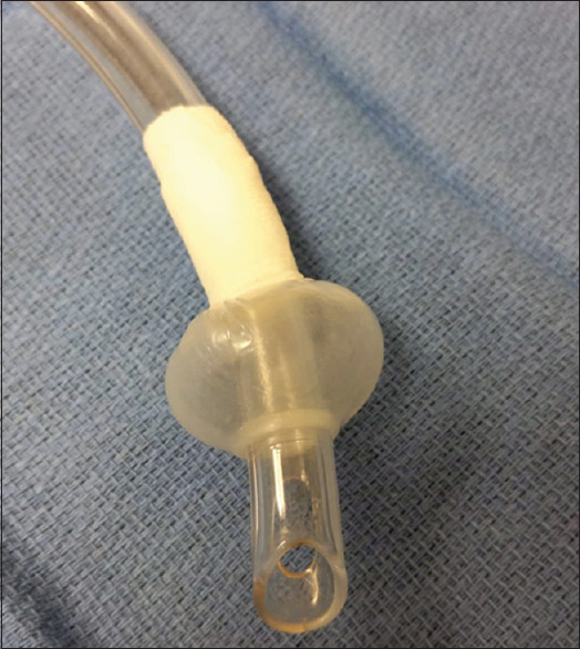 Intraoperative Innovation Leading to a Modified Endotracheal Tube: A Case Report of Endobronchial Intubation of Total Laryngectomy Stoma.