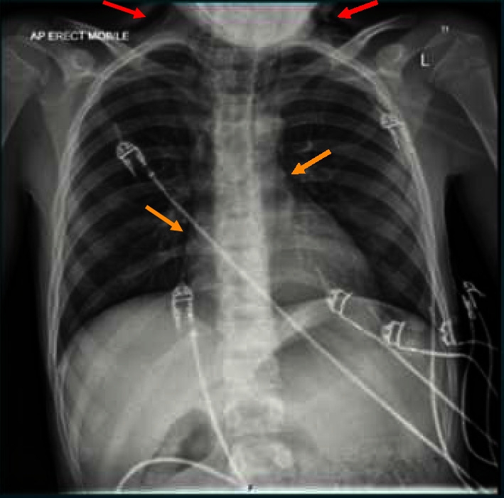 An Uncommon Presentation of Hamman's Syndrome in an Adolescent With Acute Diabetic Ketoacidosis and Newly Diagnosed Type 1 Diabetes.