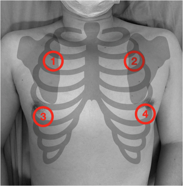 The unreliability of crackles: insights from a breath sound study using physicians and artificial intelligence.