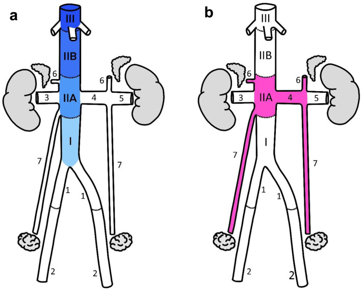 On the Origin of Abdominal Venous Leiomyosarcomas: The Role of the Sex-Hormone Drainage Pathways.