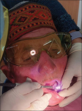 Evaluation of effect of low-level laser therapy on alleviation of pain in patients with implant-supported mandibular overdenture: A pilot study.