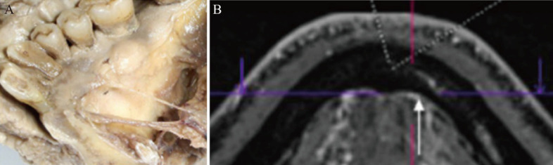 [Strategies for prevention and treatment of vascular and nerve injuries in mandibular anterior implant surgery].