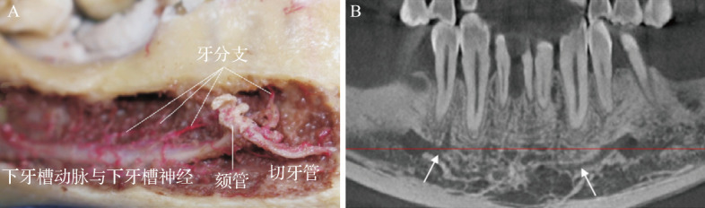 [Strategies for prevention and treatment of vascular and nerve injuries in mandibular anterior implant surgery].