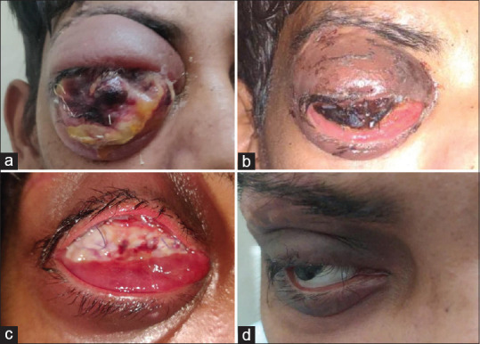 Evisceration and ocular prosthetic implantation following endovascular coiling for the management of endophthalmitis in a long-standing post-traumatic unilateral carotid-cavernous fistula: A case report and review of the literature.