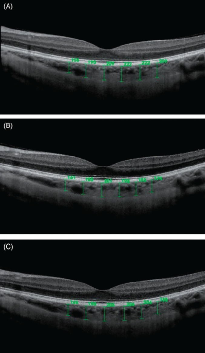 Caffeine and Vision: Effects on the Eye.