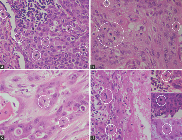 Mitosis - predicting primary tumour and metastatic lymph node behaviour and beyond in OSCC - A pilot study.