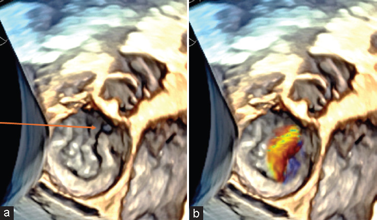 Pediatric Three-dimensional Transesophageal Echocardiography: A Game Changer in Congenital Heart Disease.