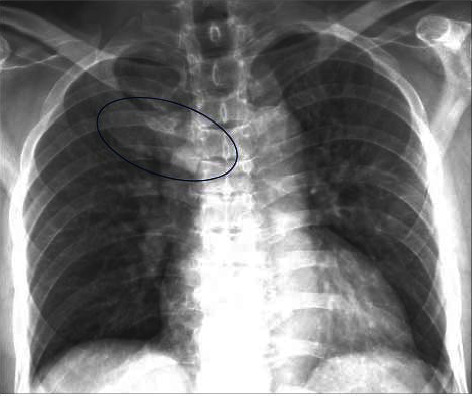 Enteropathic SAPHO Syndrome in Ulcerative Colitis Responsive to Bisphosphonates.