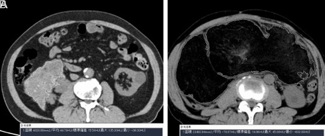 Hounsfield Unit on Preoperative Computed Tomography as an Indicator of Prognosis in Patients with Liposarcoma.