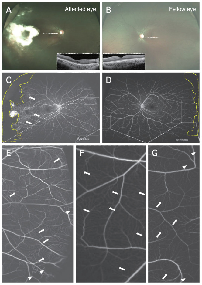 Ultra-Widefield Fluorescein Angiographic Features Influencing Visual Prognosis in Coats Disease.