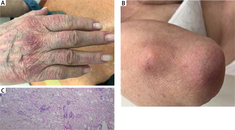Challenging diagnosis of the spectrum of reactive granulomatous dermatitis: two case reports and literature review.