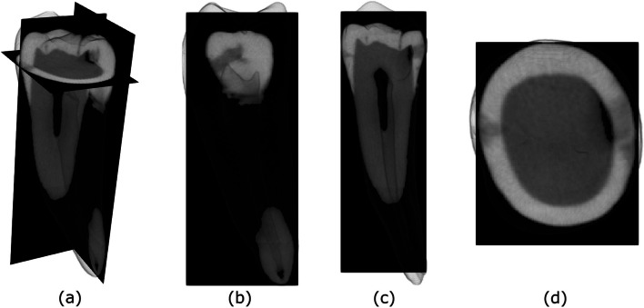 Enhancement of early proximal caries annotations in radiographs: introducing the Diagnostic Insights for Radiographic Early-caries with micro-CT (ACTA-DIRECT) dataset.
