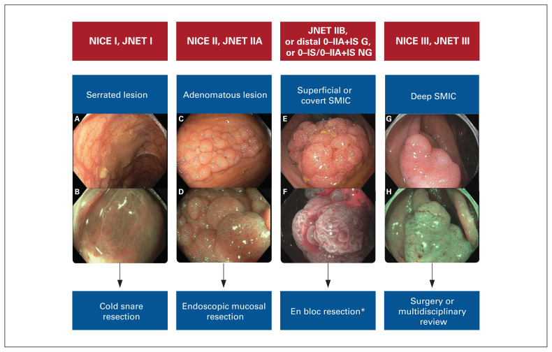 Large nonpedunculated colorectal polyp management through the lens of an interventional endoscopist.