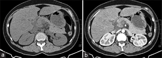 <i>In vitro</i> fertilization-induced extreme hypertriglyceridemia with secondary acute pancreatitis in emergency department: A case report and literature review.