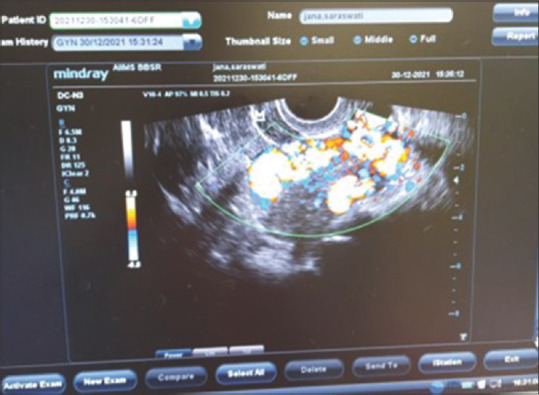 Challenges in the Management of Postmenopausal Uterine Artery Venous Malformation.