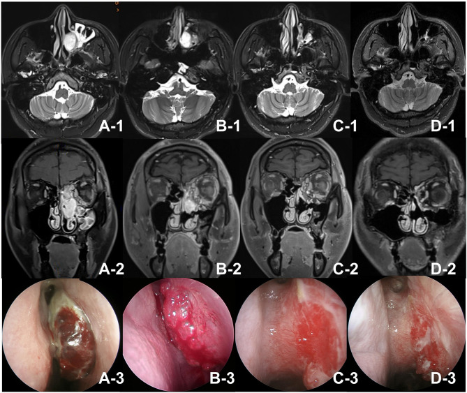 Non-Surgical Management of Recurrent Naso-Orbital Hemangiomas with Bevacizumab: A Case Report.