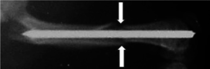 Transcutaneous CO<sub>2</sub> application combined with low-intensity pulsed ultrasound accelerates bone fracture healing in rats.