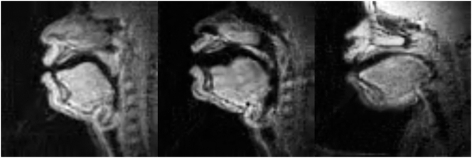 Vertical larynx actions and intergestural timing stability in Hausa ejectives and implosives.