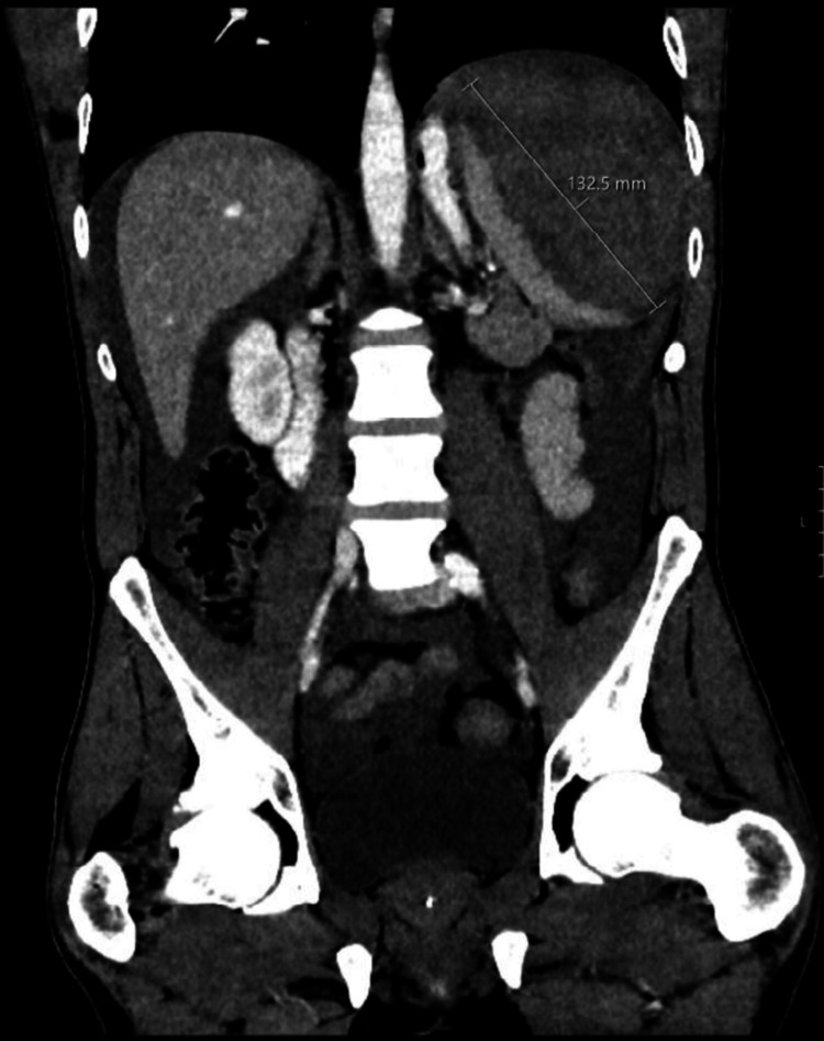 Atraumatic Splenic Rupture Unveiling Mumps With an Underlying B-cell Lymphoid Hyperplasia: A Diagnostic Conundrum.