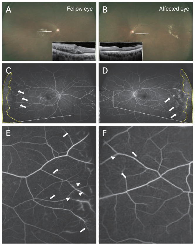 Ultra-Widefield Fluorescein Angiographic Features Influencing Visual Prognosis in Coats Disease.