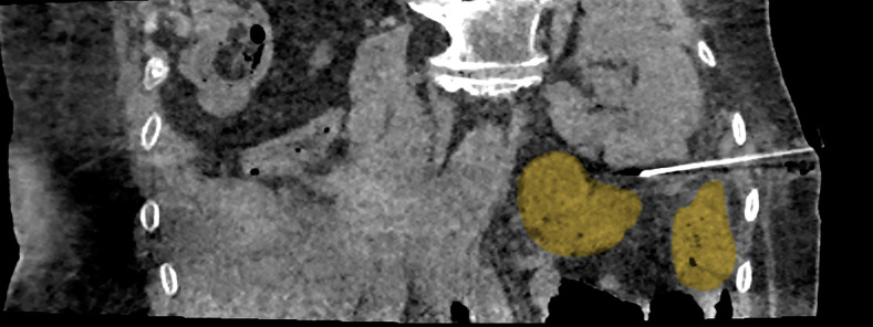 Percutaneous cryoablation of kidney tumors after partial nephrectomy.