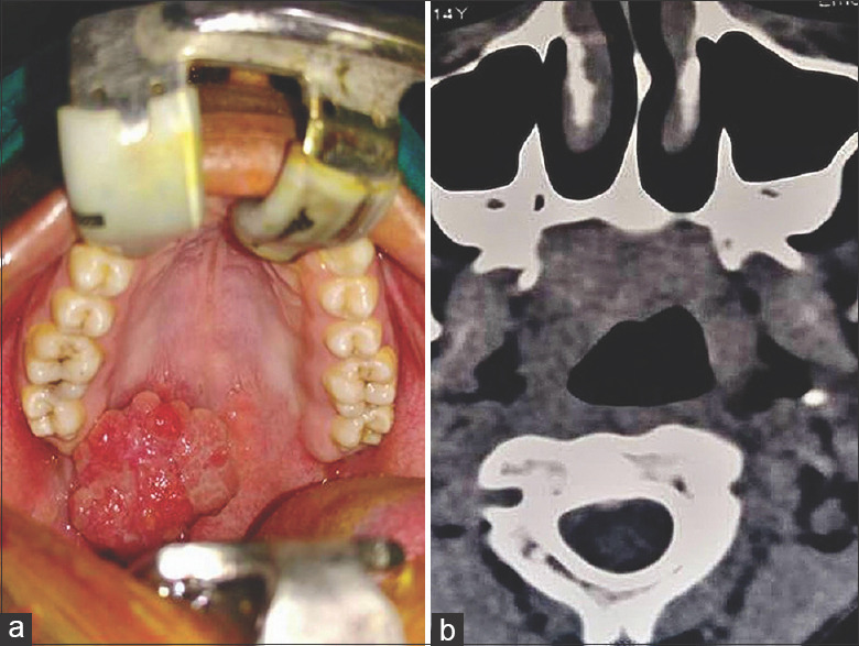 Pleomorphic adenoma with extensive squamous metaplasia and keratinizing cysts: Diagnostic and clinical pitfalls - A report of two cases and review of literature.