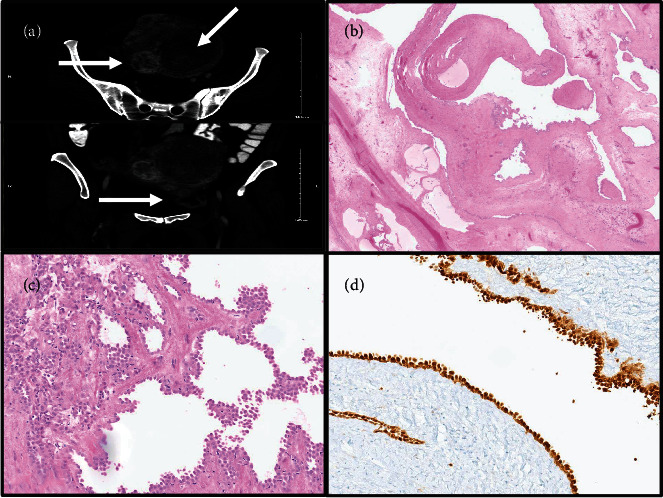 A Rare Case of Giant Cystic Adenomatoid Tumor of the Uterus With Literature Review.