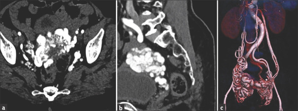 Challenges in the Management of Postmenopausal Uterine Artery Venous Malformation.