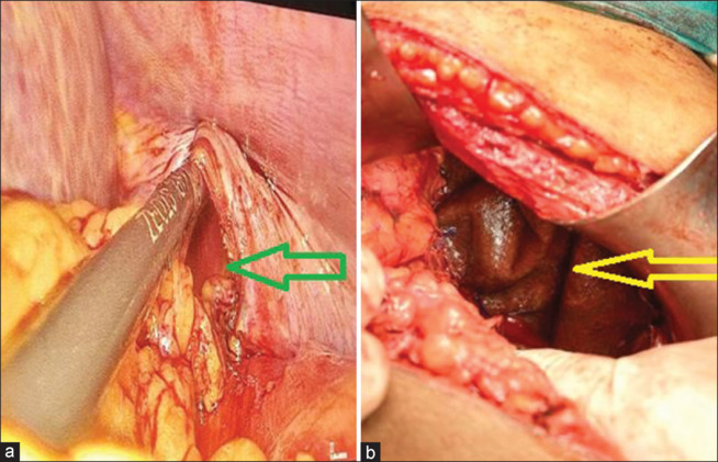Spontaneous Acquired Diaphragmatic Hernia: Case Series and Review of Literature.