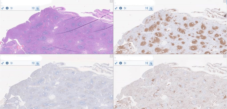 Atraumatic Splenic Rupture Unveiling Mumps With an Underlying B-cell Lymphoid Hyperplasia: A Diagnostic Conundrum.