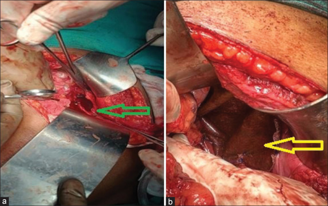 Spontaneous Acquired Diaphragmatic Hernia: Case Series and Review of Literature.
