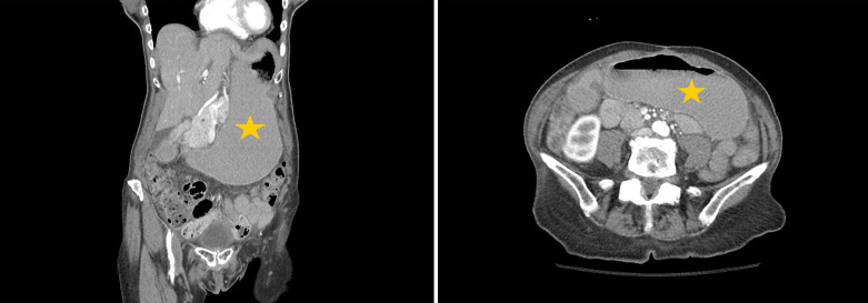 Acute Gastric Dilatation: A Retrospective Case Series from a Single Institution.