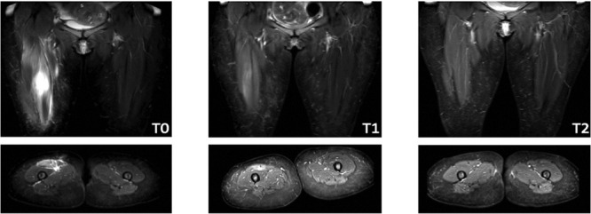 Lower limb acute onset muscle pain: what do we have to look for? A case of isolated rupture of the rectus femoris.