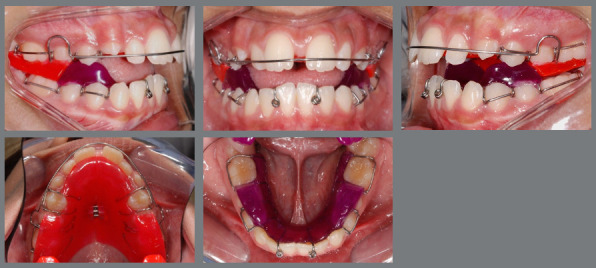 Facial soft tissue changes in adolescent patients treated with three different functional appliances: a randomized clinical trial.